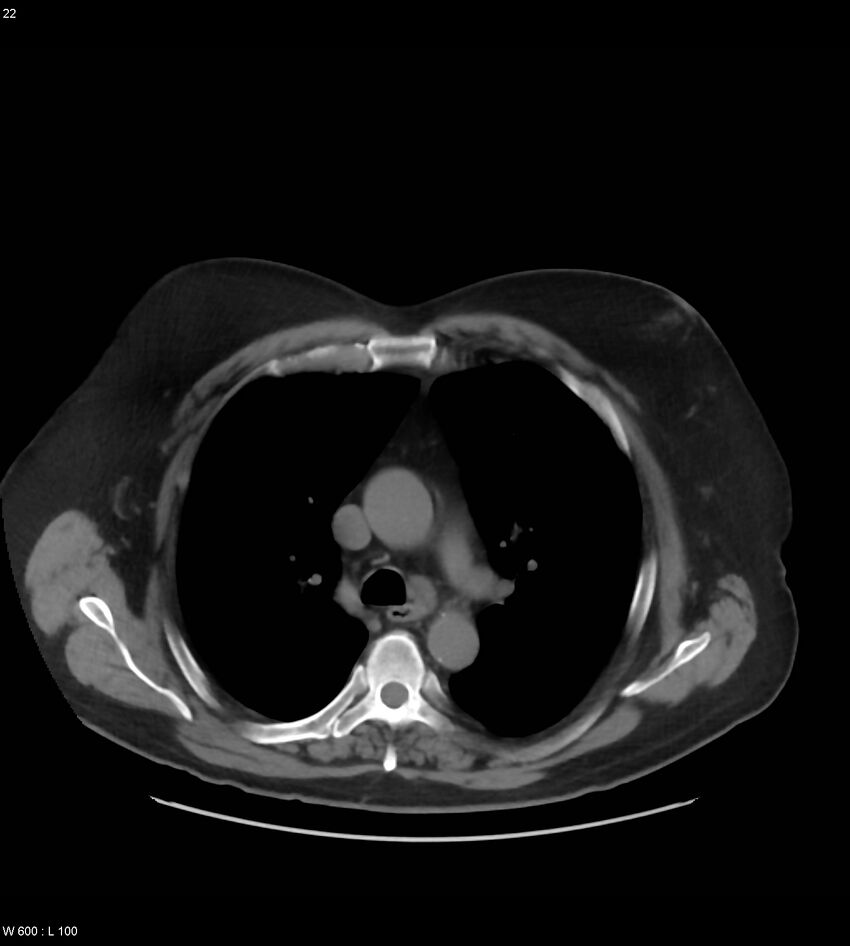 Abdominal aortic aneurysm with intramural hematoma then rupture (Radiopaedia 50278-55631 Axial non-contrast 18).jpg