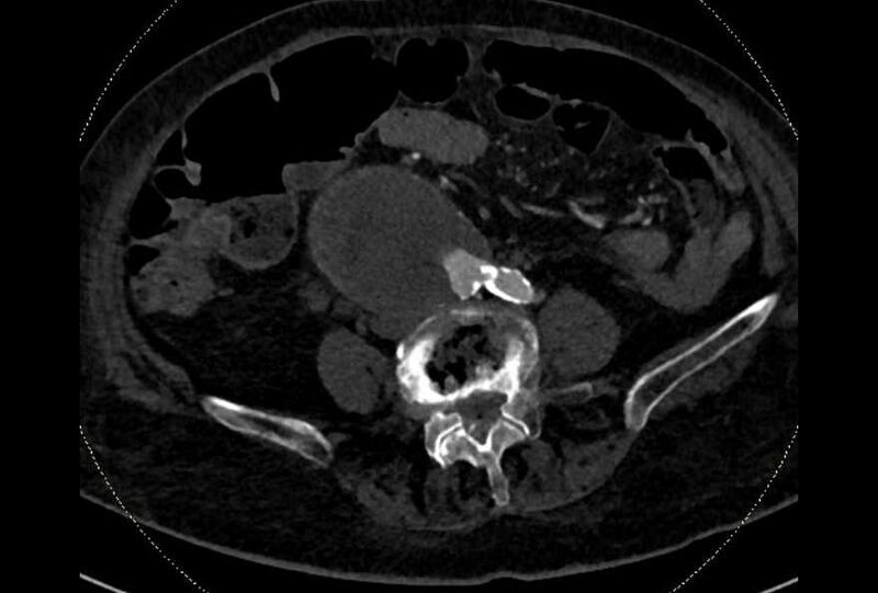 File:Abdominal aortic aneurysm with thrombus fissuration (Radiopaedia 73192-83919 Axial C+ arterial phase 136).jpg