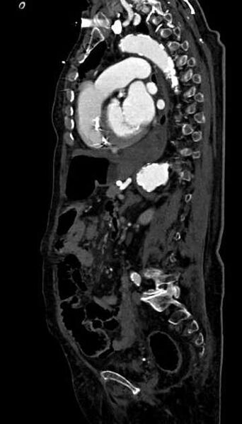 File:Abdominal aortic aneurysm with thrombus fissuration (Radiopaedia 73192-83919 Sagittal C+ arterial phase 55).jpg