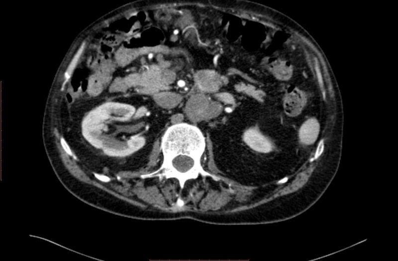 File:Abdominal aortic interposition tube graft and aneurysm thrombosis (Radiopaedia 71438-81857 Axial C+ arterial phase 45).jpg