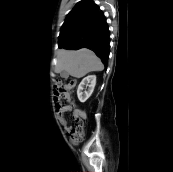 File:Abdominal aortic interposition tube graft and aneurysm thrombosis (Radiopaedia 71438-81857 Sagittal C+ arterial phase 27).jpg