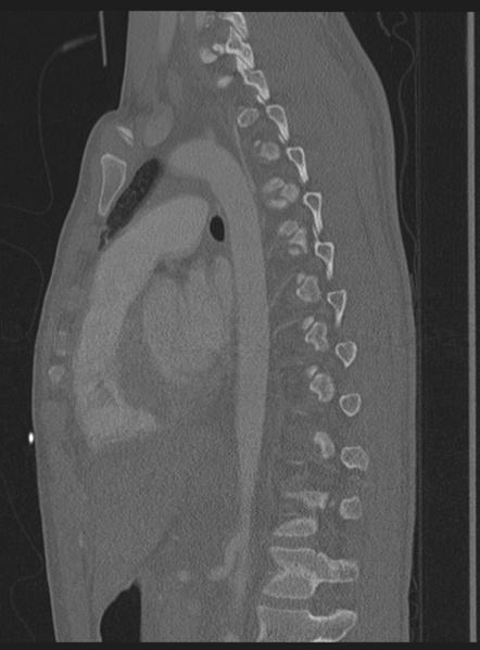 File:Abdominal multi-trauma - devascularised kidney and liver, spleen and pancreatic lacerations (Radiopaedia 34984-36486 Sagittal bone window 23).png
