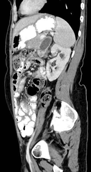 File:Abdominal wall and retroperitoneal tuberculosis (Radiopaedia 88137-104729 Sagittal C+ portal venous phase 50).jpg