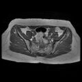 Abdominal wall endometriosis (Radiopaedia 83702-98847 Axial T1 5).jpg