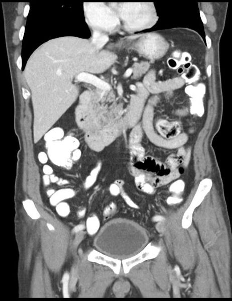 File:Abdominal wall metastasis from colorectal carcinoma (Radiopaedia 31016-31717 Coronal C+ portal venous phase 21).jpg