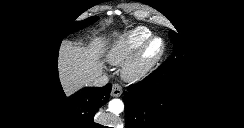 File:Aberrant left main coronary artery (ALMCA) arising from the right sinus with interarterial course (Radiopaedia 63251-71814 Axial C+ arterial phase 173).JPG