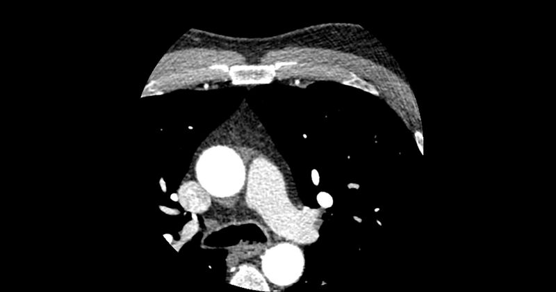 File:Aberrant left main coronary artery (ALMCA) arising from the right sinus with interarterial course (Radiopaedia 63251-71814 Axial C+ arterial phase 2).JPG