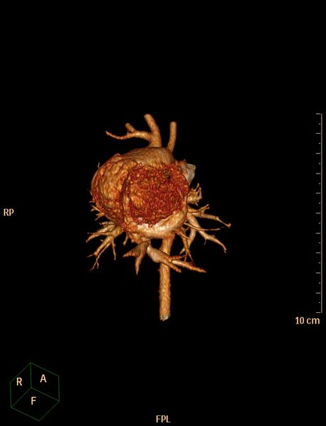 File:Aberrant left pulmonary artery (pulmonary sling) (Radiopaedia 42323-45435 3D reconstruction C+ CTPA 3).jpg