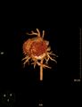 Aberrant left pulmonary artery (pulmonary sling) (Radiopaedia 42323-45435 3D reconstruction C+ CTPA 3).jpg