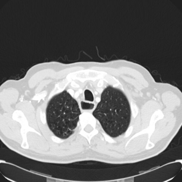 File:Achalasia (Radiopaedia 24937-25206 Axial lung window 4).jpg