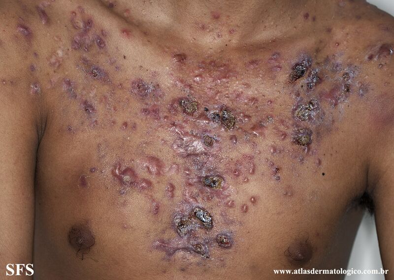 File:Acne Fulminans (Dermatology Atlas 10).jpg
