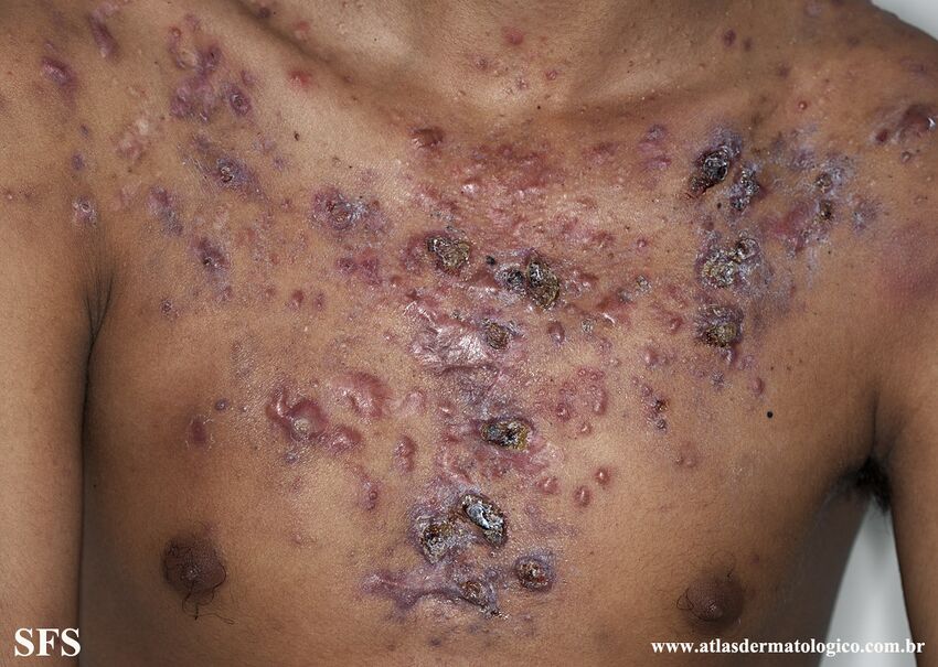 Acne Fulminans (Dermatology Atlas 10).jpg