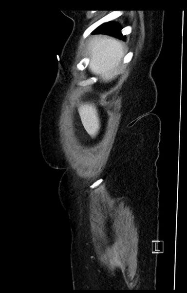 File:Active Crohn disease (Radiopaedia 59394-66750 Sagittal C+ portal venous phase 53).jpg