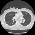 Active right ventricular cardiac sarcoidosis (Radiopaedia 55596-62101 Axial lung window 20).jpg