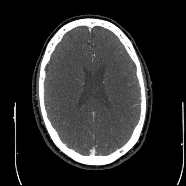 File:Acute A3 occlusion with ACA ischemic penumbra (CT perfusion) (Radiopaedia 72036-82527 Axial C+ arterial phase thins 37).jpg