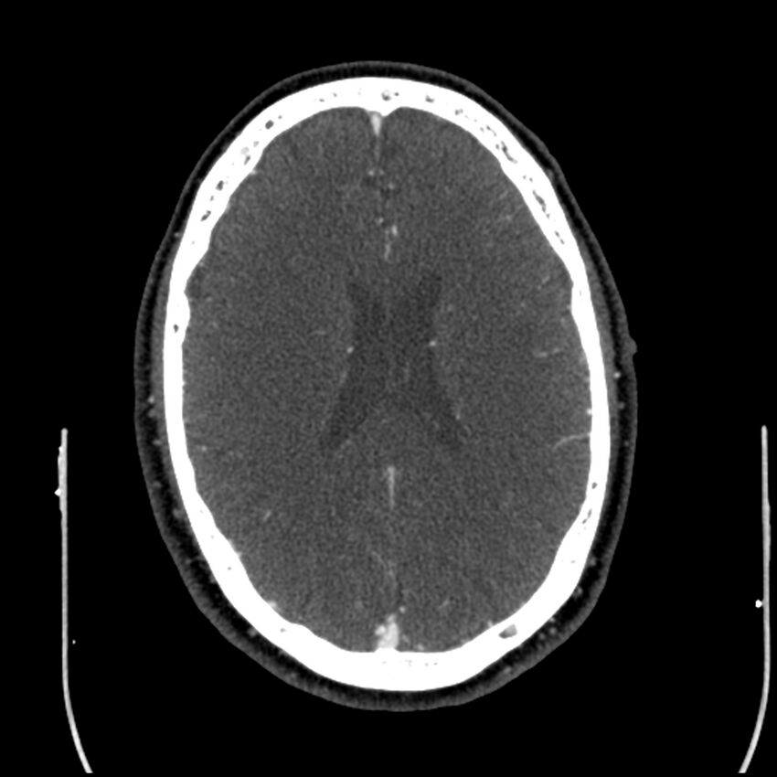 Acute A3 occlusion with ACA ischemic penumbra (CT perfusion) (Radiopaedia 72036-82527 Axial C+ arterial phase thins 37).jpg