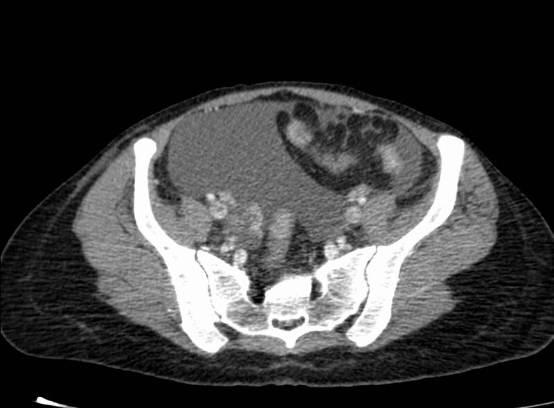 File:Acute Budd-Chiari syndrome (Radiopaedia 60858-68638 Axial C+ portal venous phase 236).jpg