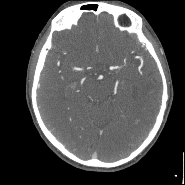File:Acute P1 occlusion with PCA ischemia penumbra (CT perfusion) (Radiopaedia 72084-82587 Axial C+ arterial thins 33).jpg