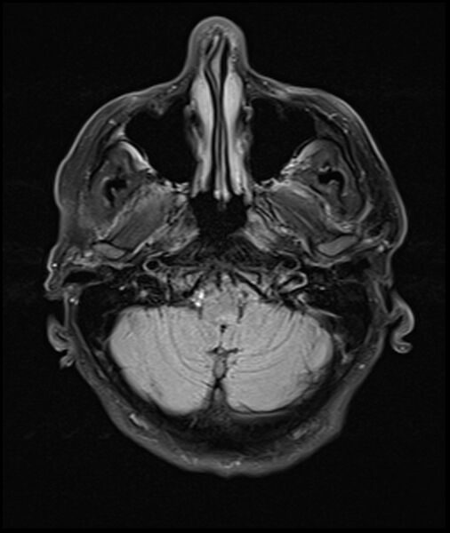 File:Acute P1 occlusion with PCA ischemia penumbra (CT perfusion) (Radiopaedia 72084-82590 Axial FLAIR 5).jpg