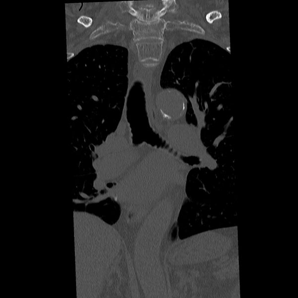 File:Acute and chronic vertebral compression fractures (Radiopaedia 31608-32494 Coronal bone window 5).jpg