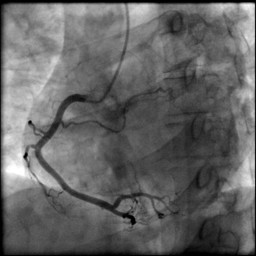 Acute anteroseptal myocardial infarction (Radiopaedia 68409-77946 RAO straight RCA 33).jpg