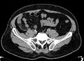 Acute appendicitis (Radiopaedia 13030-13091 Axial non-contrast 26).jpg