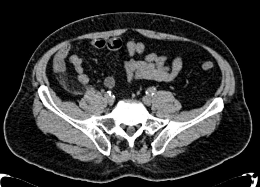 Acute appendicitis (Radiopaedia 13030-13091 Axial non-contrast 26).jpg