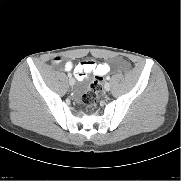 File:Acute appendicitis (Radiopaedia 25364-25615 B 58).jpg