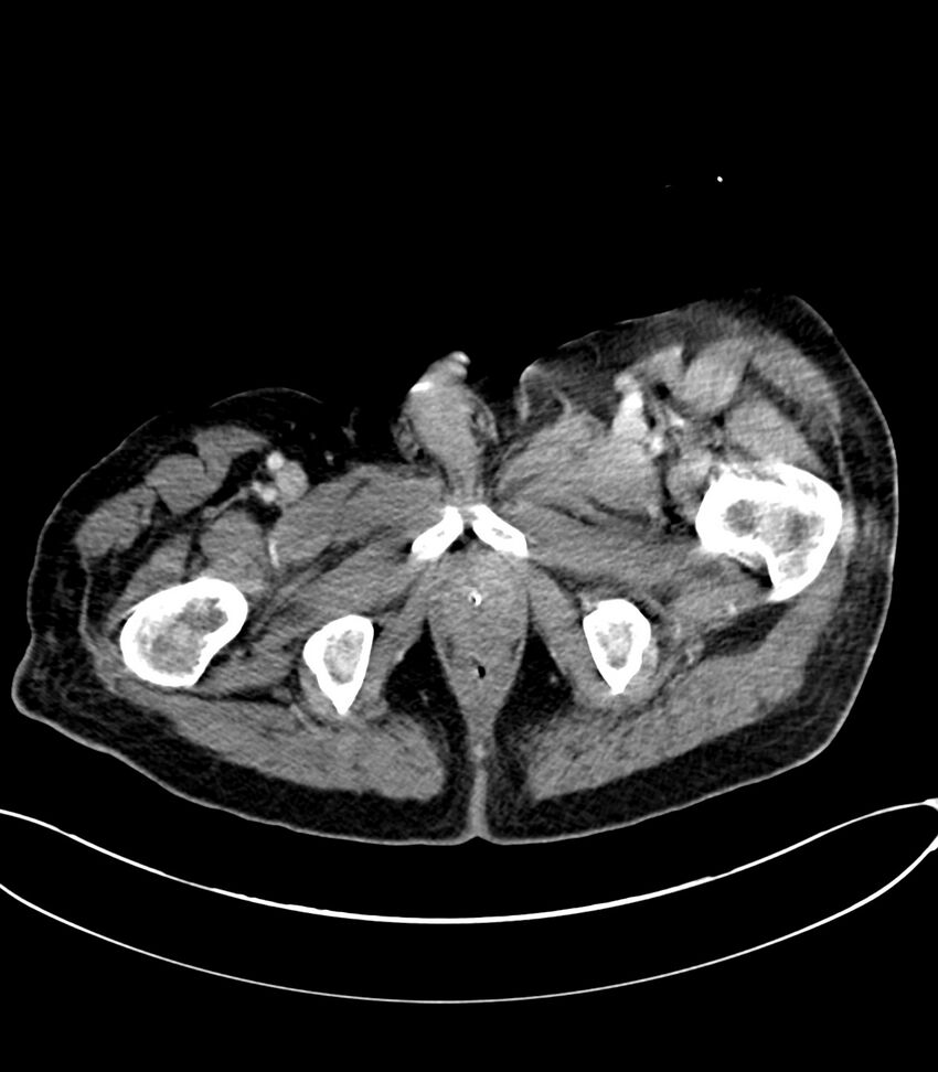 Acute arterial mesenteric ischemia (Radiopaedia 78238-90828 Axial C+ portal venous phase 148).jpg