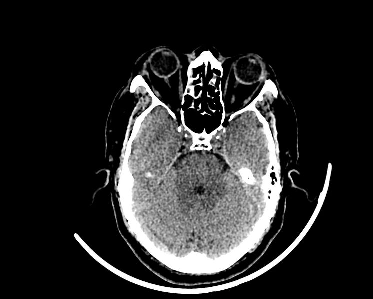 File:Acute cerebral infarct (Radiopaedia 35604-37123 Axial non-contrast 29).jpg