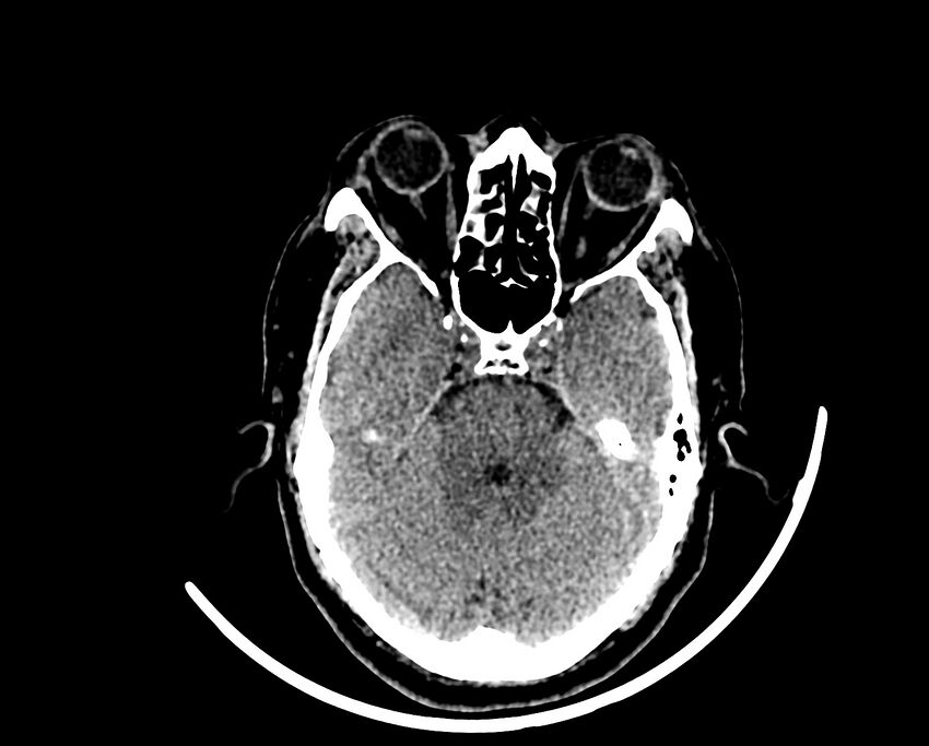 Acute cerebral infarct (Radiopaedia 35604-37123 Axial non-contrast 29).jpg