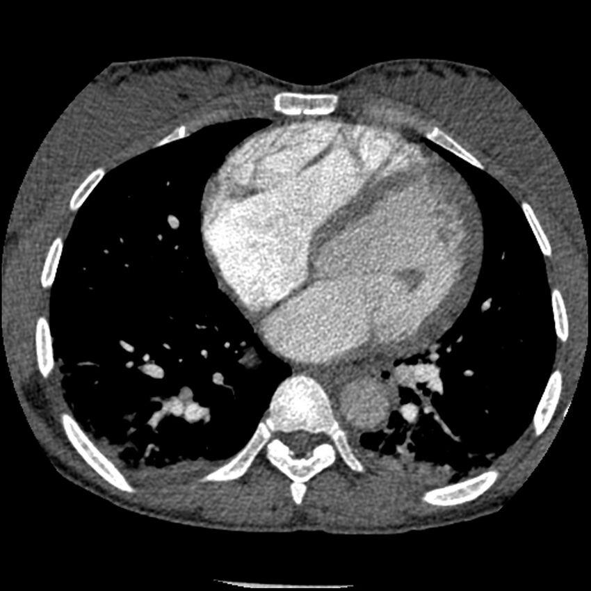 Acute chest syndrome - sickle cell disease (Radiopaedia 42375-45499 Axial C+ CTPA 118).jpg