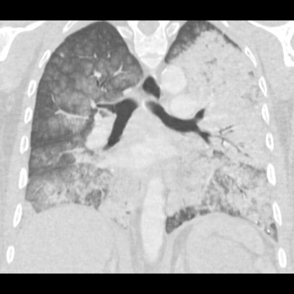 File:Acute diffuse alveolar hemorrhage (Radiopaedia 41323-44158 Coronal lung window 32).jpg