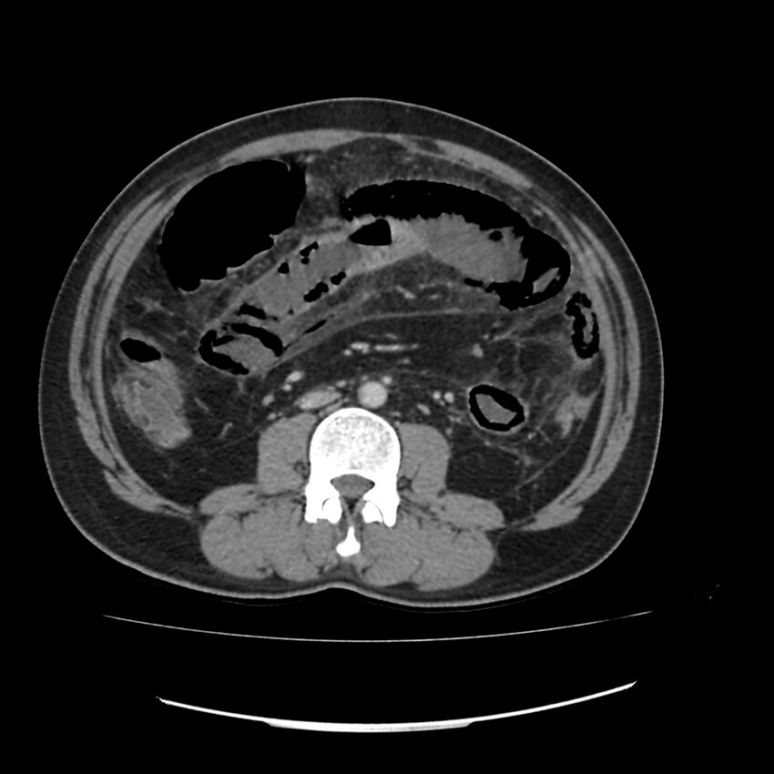 Acute mesenteric ischemia - superior mesenteric artery thrombosis (Radiopaedia 73947-84776 Axial C+ portal venous phase 74).jpg