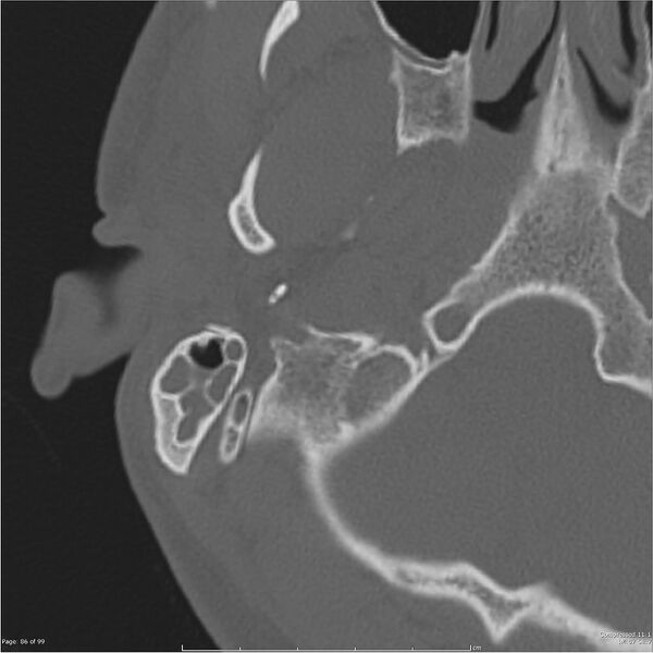 File:Acute otomastoiditis (Radiopaedia 28276-28512 Axial PTB bone window reformat 66).jpg