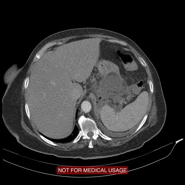 File:Acute pancreatitis with infected necrosis (Radiopaedia 26454-26585 Axial C+ arterial phase 5).jpg