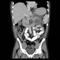 Acute pancreatitis with walled off pancreatic necrosis (Radiopaedia 6438-7797 Coronal C+ portal venous phase 5).jpg