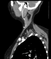 Acute parotitis (Radiopaedia 27425-27619 Sagittal C+ portal venous phase 46).png