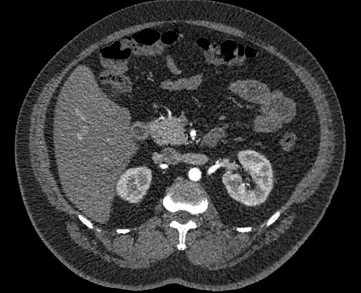 File:Acute pulmonary embolism with pulmonary infarcts (Radiopaedia 77688-89908 Axial C+ CTPA 89).jpg