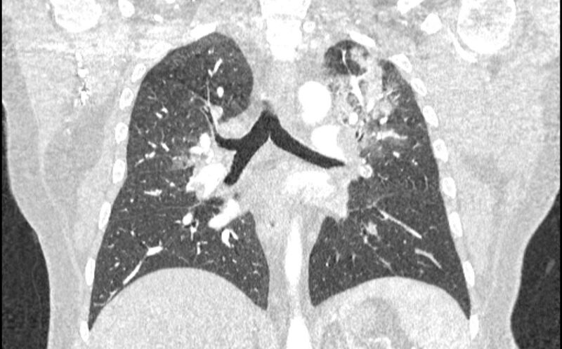 File:Acute pulmonary embolism with pulmonary infarcts (Radiopaedia 77688-89908 Coronal lung window 57).jpg