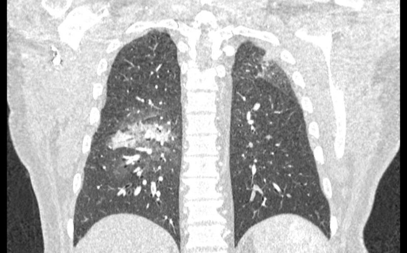 File:Acute pulmonary embolism with pulmonary infarcts (Radiopaedia 77688-89908 Coronal lung window 75).jpg