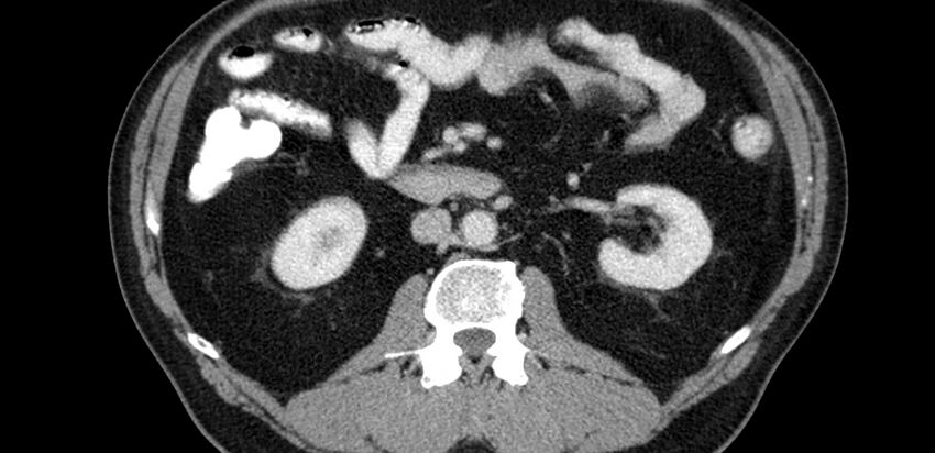 Acute sigmoid colon diverticulitis (Radiopaedia 55507-61976 Axial C+ portal venous phase 4).jpg