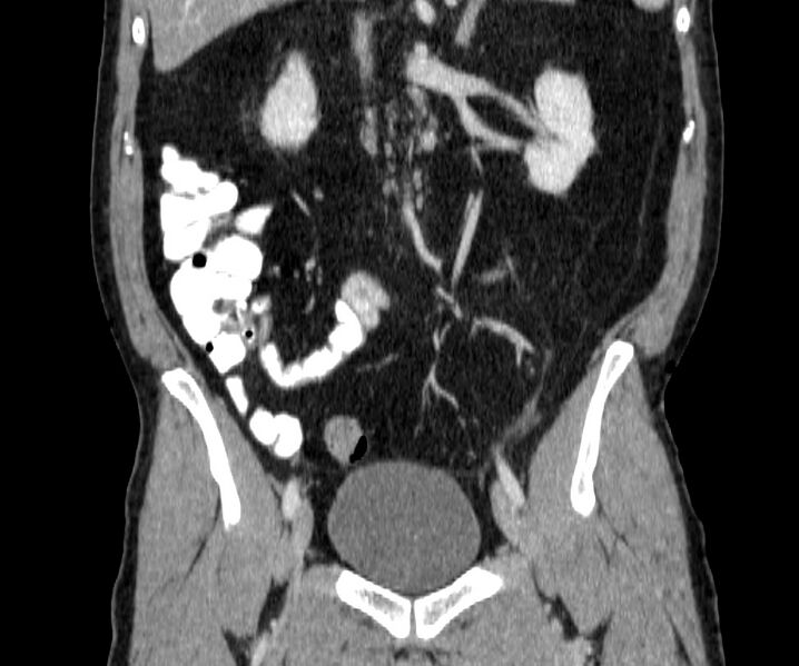 File:Acute sigmoid colon diverticulitis (Radiopaedia 55507-61976 Coronal C+ portal venous phase 78).jpg