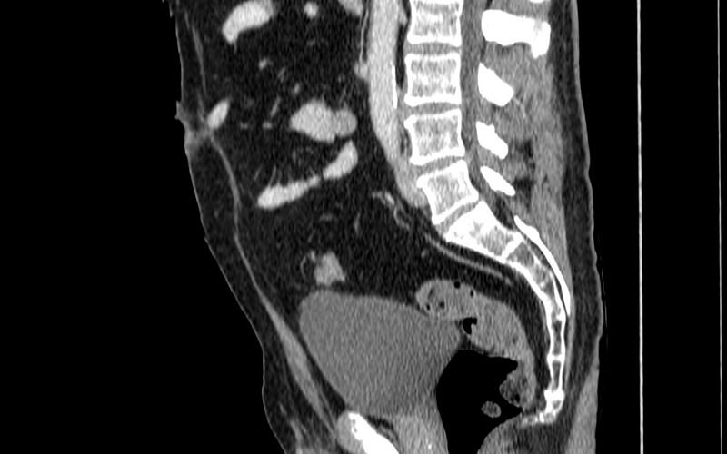 File:Acute sigmoid colon diverticulitis (Radiopaedia 55507-61976 Sagittal C+ portal venous phase 2).jpg