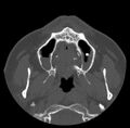 Acute sinusitis (Radiopaedia 23161-23215 Axial bone window 9).jpg