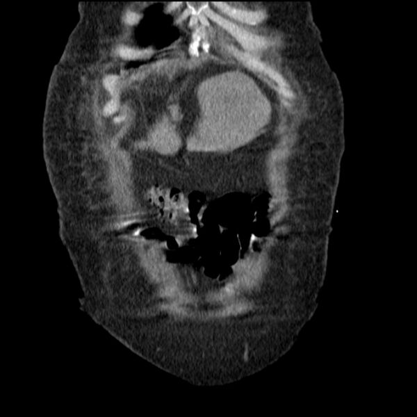 File:Acute tubular necrosis (Radiopaedia 28077-28334 G 16).jpg