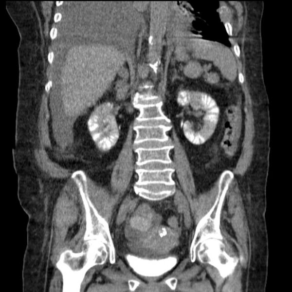 File:Acute tubular necrosis (Radiopaedia 28077-28334 G 53).jpg