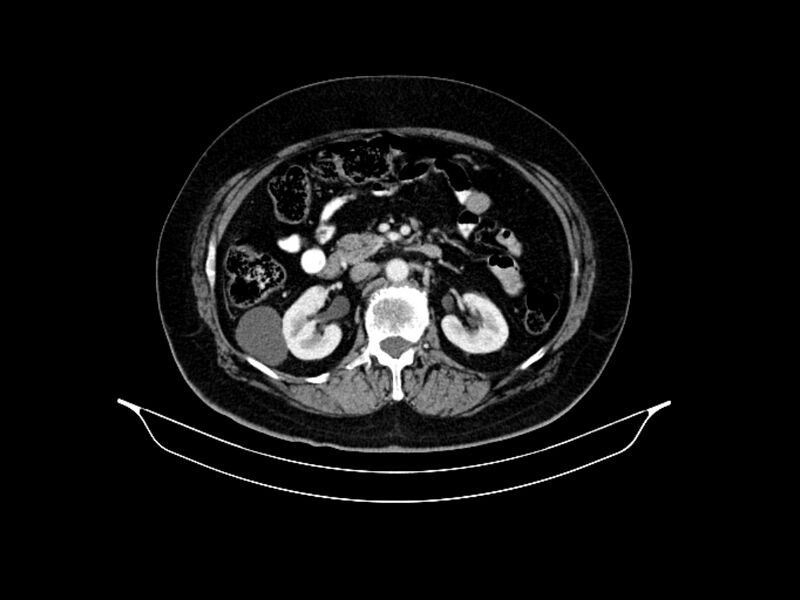 File:Adenocarcinoma of pancreas with hepatic metastasis (Radiopaedia 64332-73122 Axial C+ portal venous phase 44).jpg