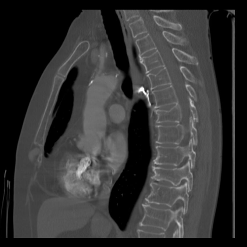 Adenocarcinoma of the lung (Radiopaedia 41015-43755 Sagittal bone window 52).jpg