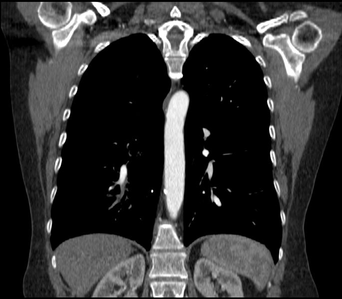 File:Adenocarcinoma of the lung (Radiopaedia 44205-47803 Coronal C+ portal venous phase 63).jpg